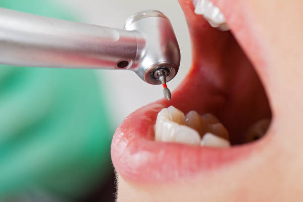 Best Emergency Wisdom Teeth Removal in Fulshear, TX